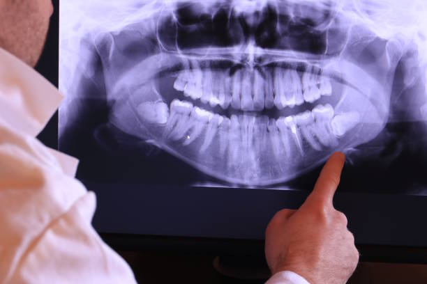 Best Emergency Wisdom Tooth Extraction in Linden, AL